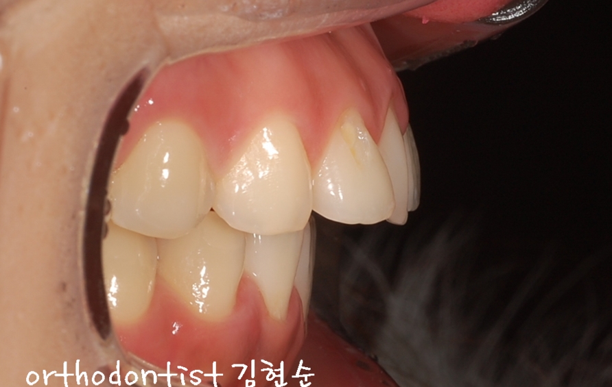 세라믹교정 은 세라믹치과 돌출입교정 관련 이미지 3