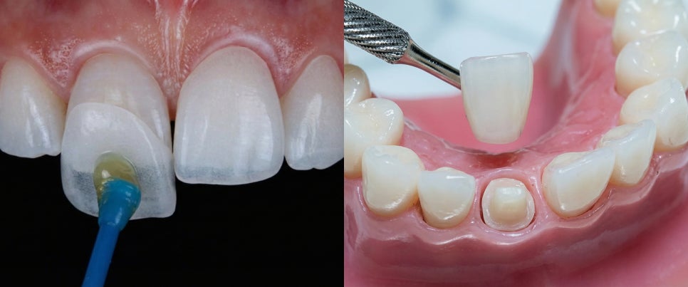 논현역 치과, 치아를 갈아내지 않는 무삭제 라미네이트 관련 이미지 4