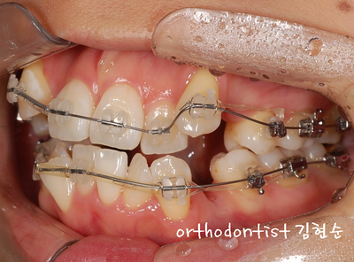 강남 덧니 관련 이미지 17