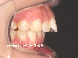 학동역 돌출입교정 세라믹치과 관련 이미지 4