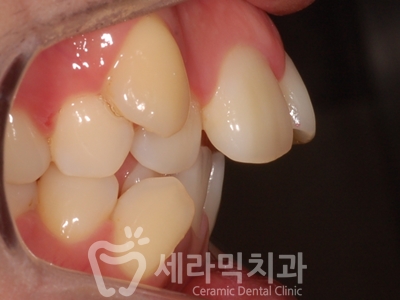 덧니와 돌출입을 한번에! 치아교정 전후사진 관련 이미지 11