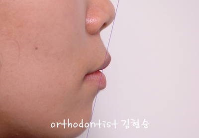 강남 돌출 관련 이미지 30