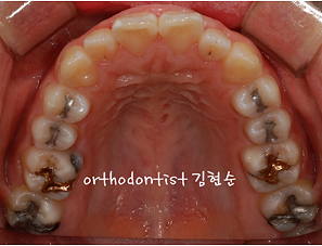 강남 돌출입 교정 관련 이미지 4
