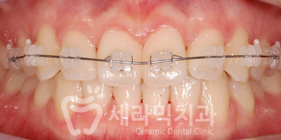 벌어진 앞니, 치아 사이 공간 교정 잘하는 세라믹치과 관련 이미지 4