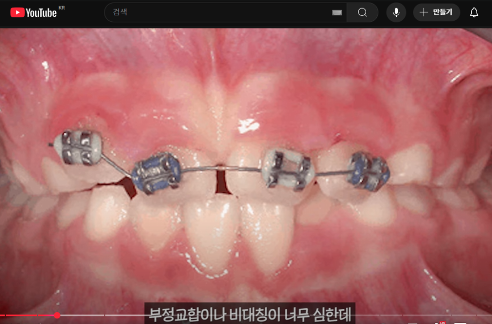 토끼이빨 앞니 부분교정, 실패하지 않는 방법은 관련 이미지 4