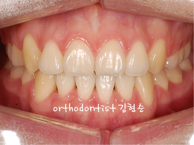 치열 교정(치열 불규칙) 관련 이미지 25