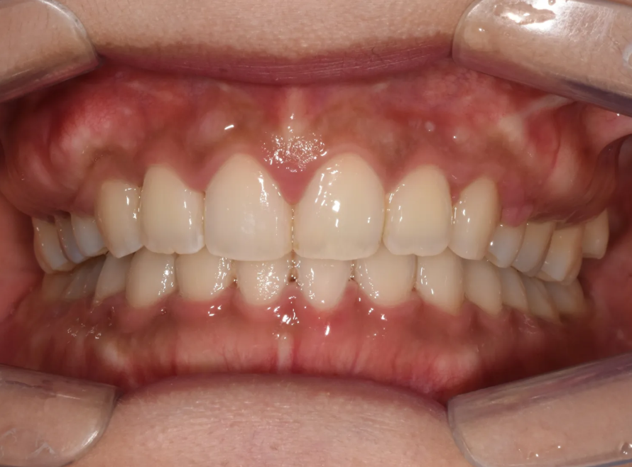 과개교합 교정: 비수술로 치료한 토끼 이빨 이야기 관련 이미지 10