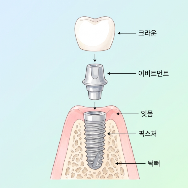 신사역 치과, 임플란트 후 관리방법 정리해보기 관련 이미지 3