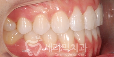 앞니 돌출, 나비치아를 남몰래 해결한 치아교정 전후! 관련 이미지 21