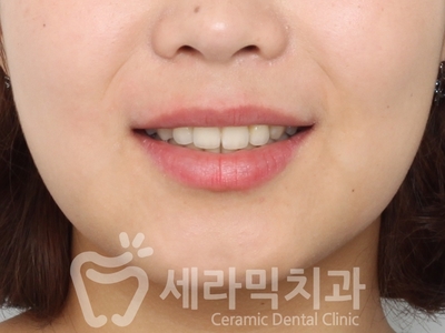 돌출입치아교정 전후사진(발치교정, 토끼이빨 인상변화) 관련 이미지 6