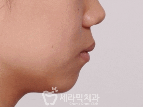 치아교정전후 영상. 돌출입교정 후 얼굴 인상변화 관련 이미지 1