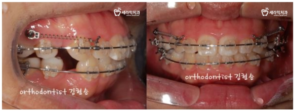 돌출 교정 월15만원 관련 이미지 9