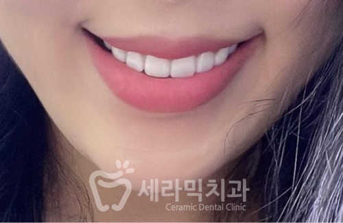 무삭제 라미네이트라면서? 대체 얼마나 삭제하는거죠? 관련 이미지 1