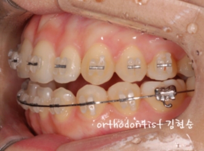 강남교정치과 관련 이미지 28