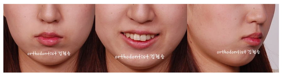 토끼 이빨? 뻐드렁니 컴플렉스? 돌출입에 대해 알아보기 관련 이미지 3