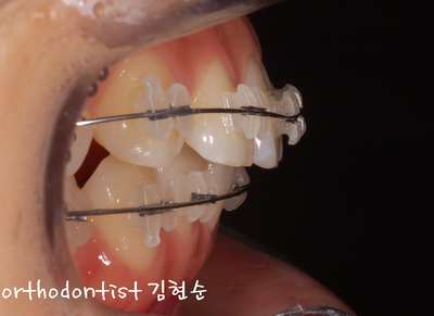 돌출 교정 (비발치 교정/비대칭) 관련 이미지 16