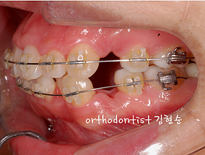 강남 돌출입 교정 관련 이미지 28