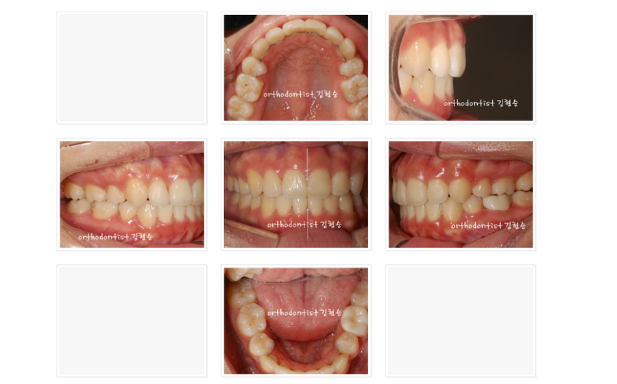 돌출입 발치교정, 미니스크류를 통한 6가지 변화 관련 이미지 12