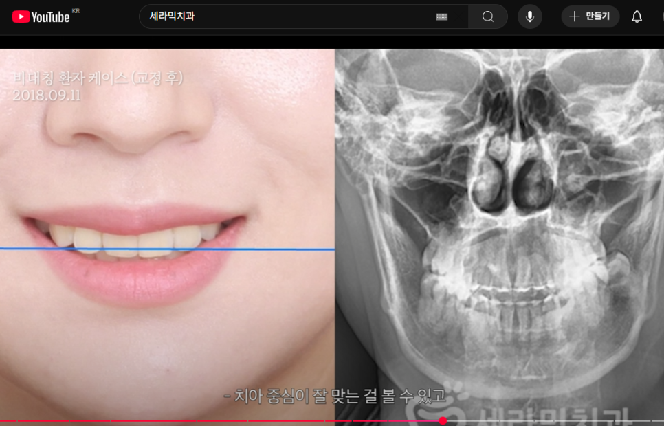 좌우 얼굴비대칭 원인, 문제점, 치료방법 - 비수술 치아교정 관련 이미지 4
