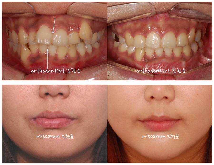 발치 교정으로 덧니 치열 올바로 잡기 관련 이미지 9