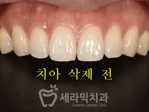 무삭제 라미네이트라면서? 대체 얼마나 삭제하는거죠? 관련 이미지 7