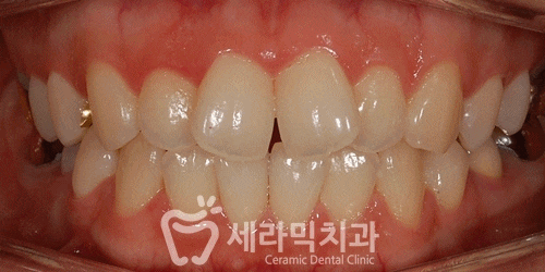 벌어진 나비치아 돌출입 치아교정전후 관련 이미지 3