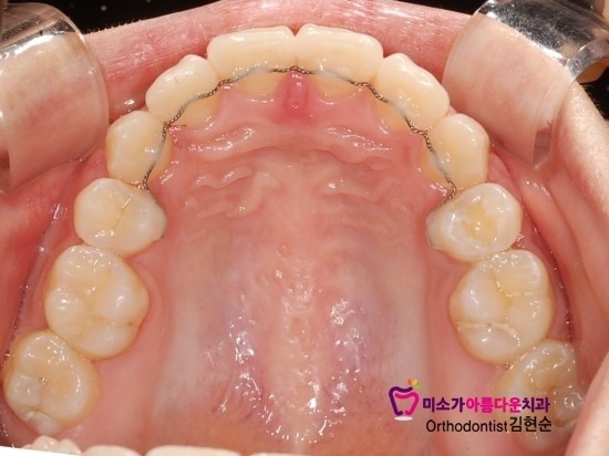 논현동교정잘하는치과 미소가아름다운치과 고객님 후기입니다 관련 이미지 4