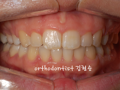 강남 돌출 관련 이미지 27