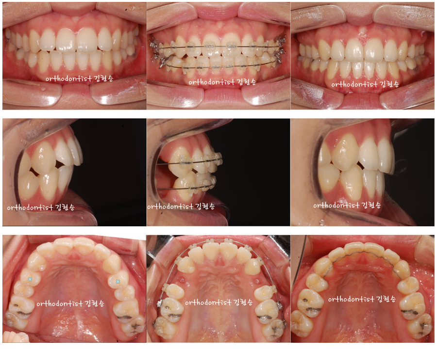 세라믹교정 세라믹치과-돌출입발치교정 6 관련 이미지 3