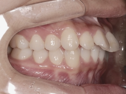 학동역치과 하면 세라믹교정 ~ 관련 이미지 16