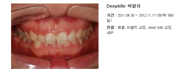 과개교합 ABP 교정 관련 이미지 2