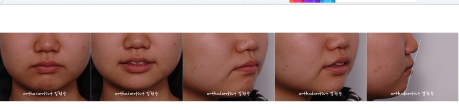 세라믹교정 은 세라믹치과 발치비발치 해결 관련 이미지 7