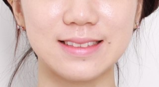 3D 스캐너를 이용한 교정 심뮬레이션 관련 이미지 2