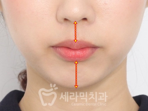 앞니 돌출, 개방교합으로 치아교정을 시작했는데, 작았던 아래턱이 커졌어요! 관련 이미지 12