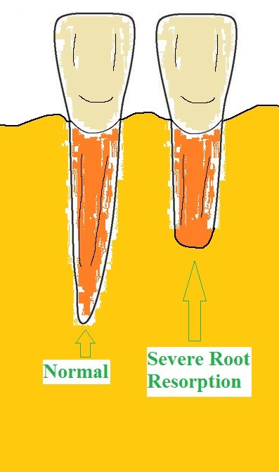 세라믹교정 가격 4대부작용 관련 이미지 6