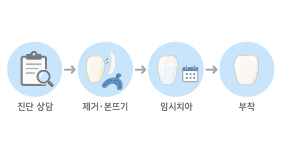 논현동 라미네이트 재시술 몇 번 내원하고 얼마나 걸릴까: 처음과 달라지는 것 관련 이미지 2
