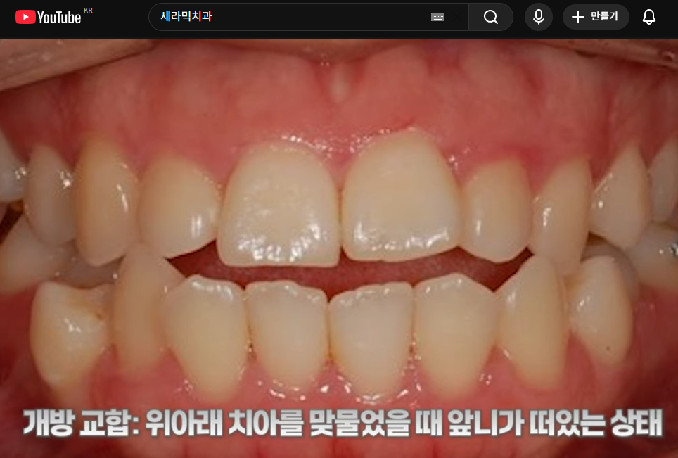 개방교합은 재발률이 높다? 치아교정 후 관리방법 (feat.유지장치) 관련 이미지 2