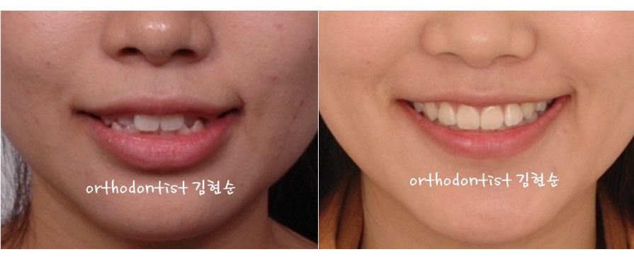 세라믹교정 은 세라믹치과 수술없이 돌출개선 관련 이미지 9