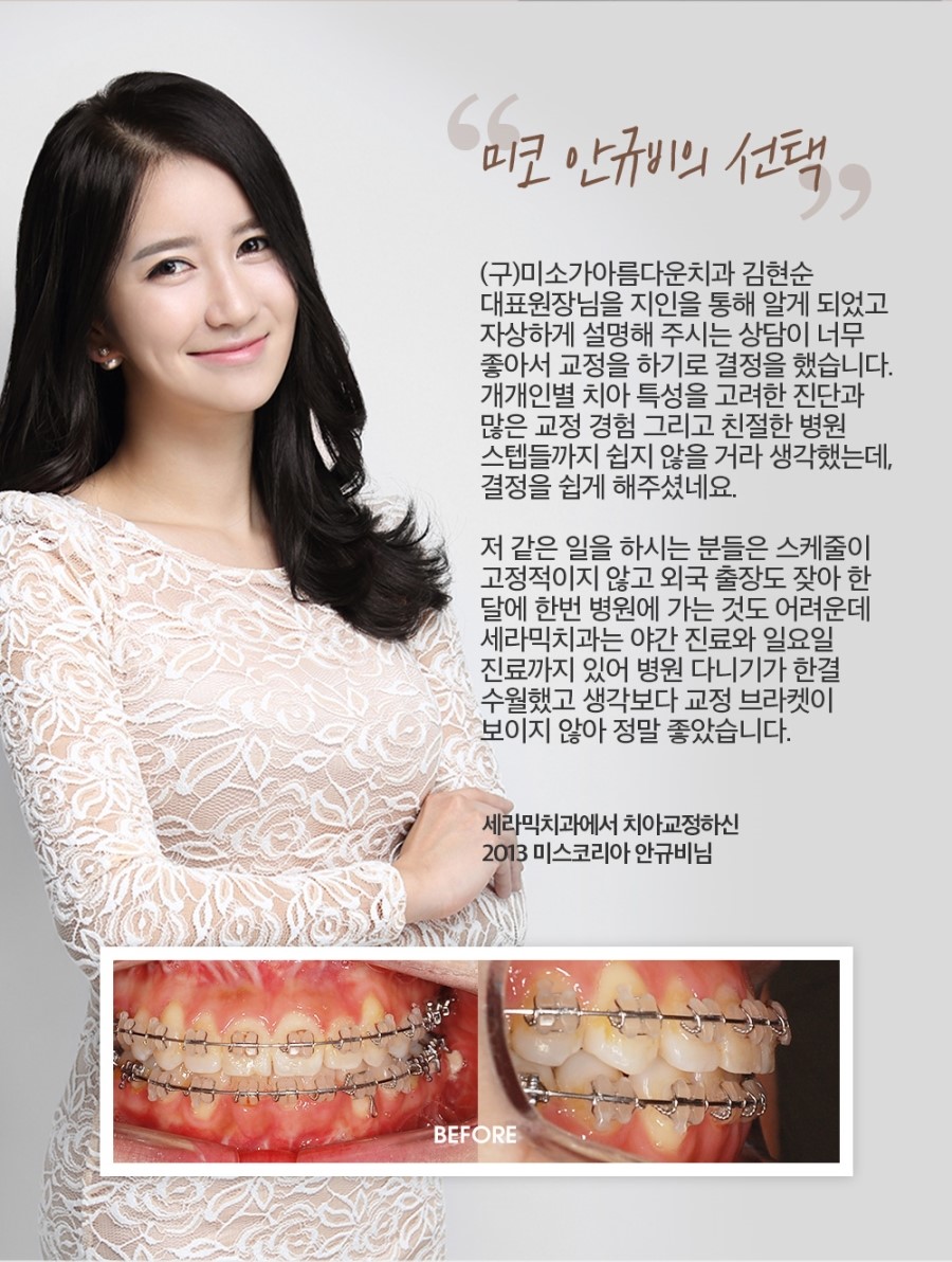 세라믹교정 이벤트 관련 이미지 9