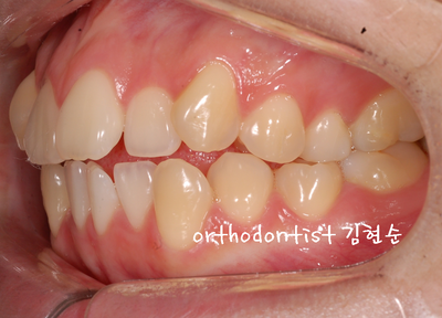 치열 교정(치열 불규칙) 관련 이미지 10
