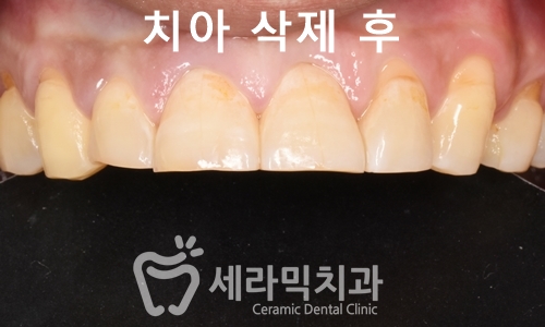 치아교정과 라미네이트는 선택이 아닌 상호 보완관계! 관련 이미지 7