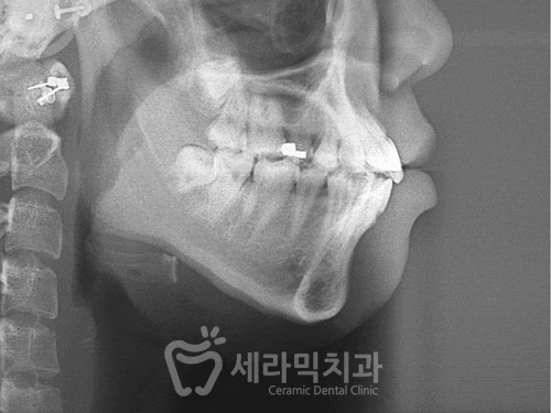 학동역 치아교정, 수술없이 예뻐져도 되나요? [돌출입교정 전후 달라진 외모] 관련 이미지 8