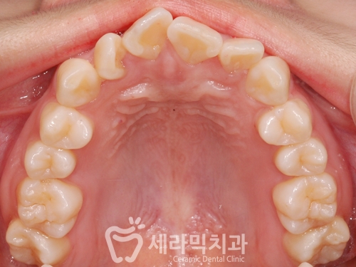 발치없이 치열불규칙교정으로 세련된 미소 완성! 관련 이미지 2