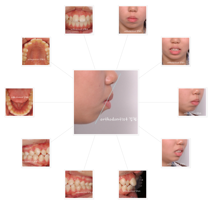 미니스크류를 이용한 발치 돌출입 교정, 무턱 개선 관련 이미지 5