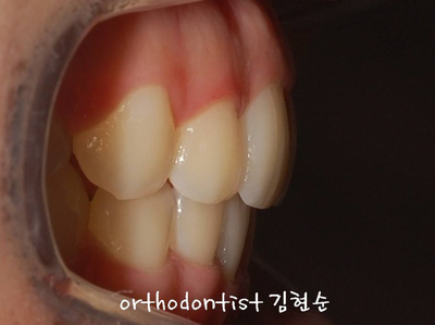 강남 돌출입 교정 관련 이미지 18