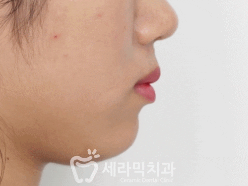 치아교정전후 돌출입, 나비치아 개선 관련 이미지 2