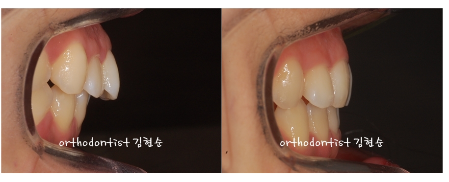 세라믹교정 은 세라믹치과 돌출입발치 관련 이미지 6
