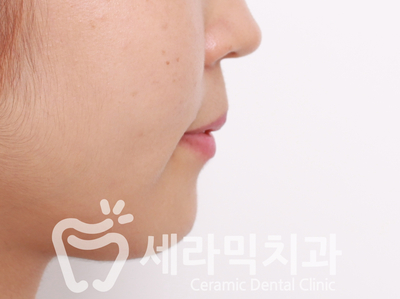 치아교정 전후 확연한 인상 변화! 관련 이미지 11
