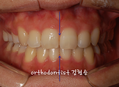 강남 돌출 관련 이미지 23