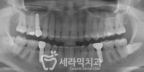 나비치아, 앞니돌출, 과개교합 치아교정전후 관련 이미지 4